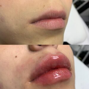 Lip Augmentation with Hyaluronic Acid Browqueen By Anabel