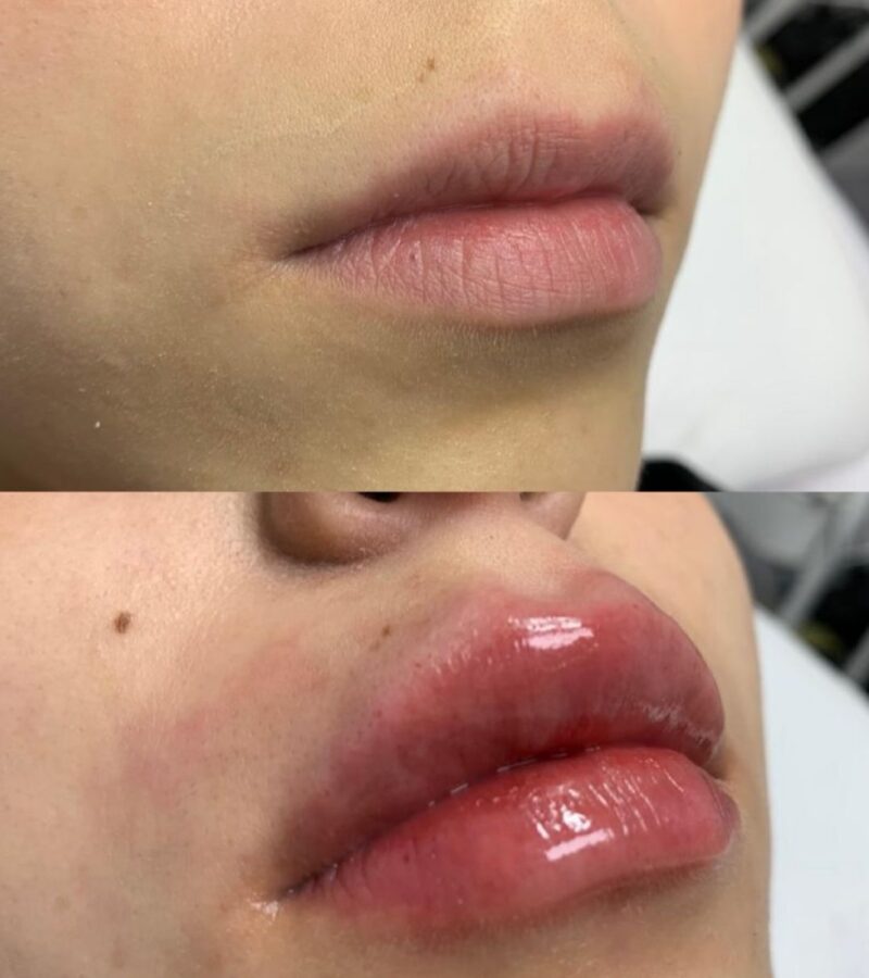 Lip Augmentation with Hyaluronic Acid Browqueen By Anabel